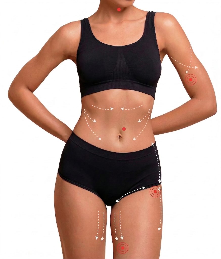 endolift